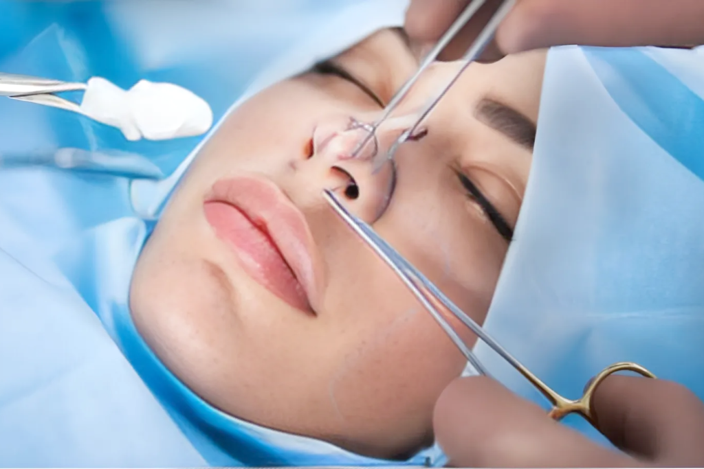 biến chứng nâng mũi chỉ