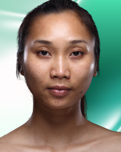 Ảnh trước nâng mũi