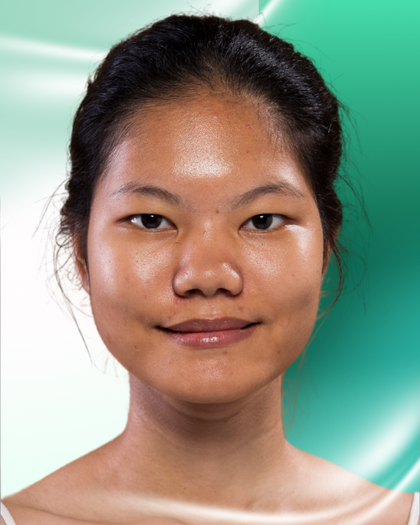 Ảnh trước nâng mũi